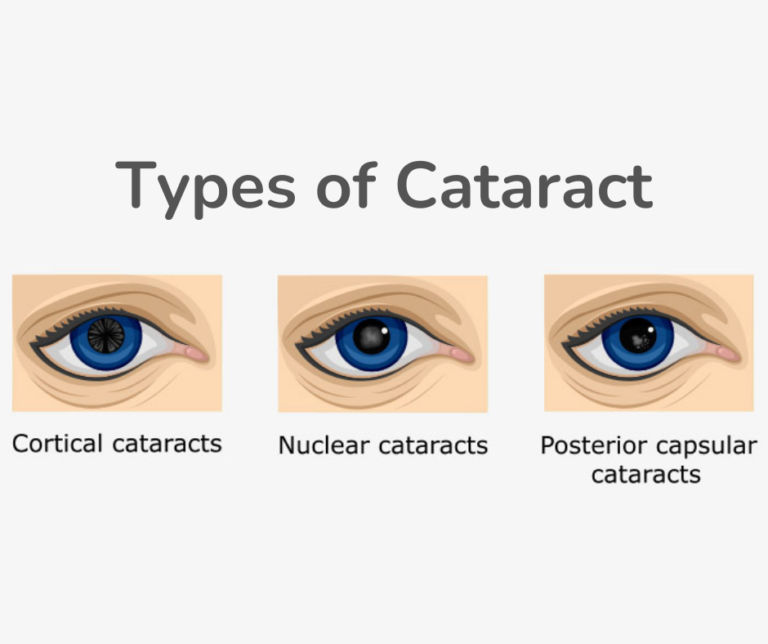 Types of Cataracts